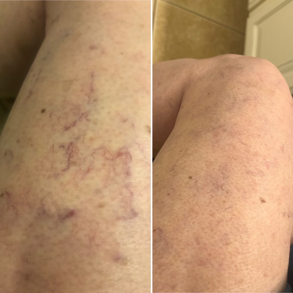 Before and after sclerotherapy treatment results