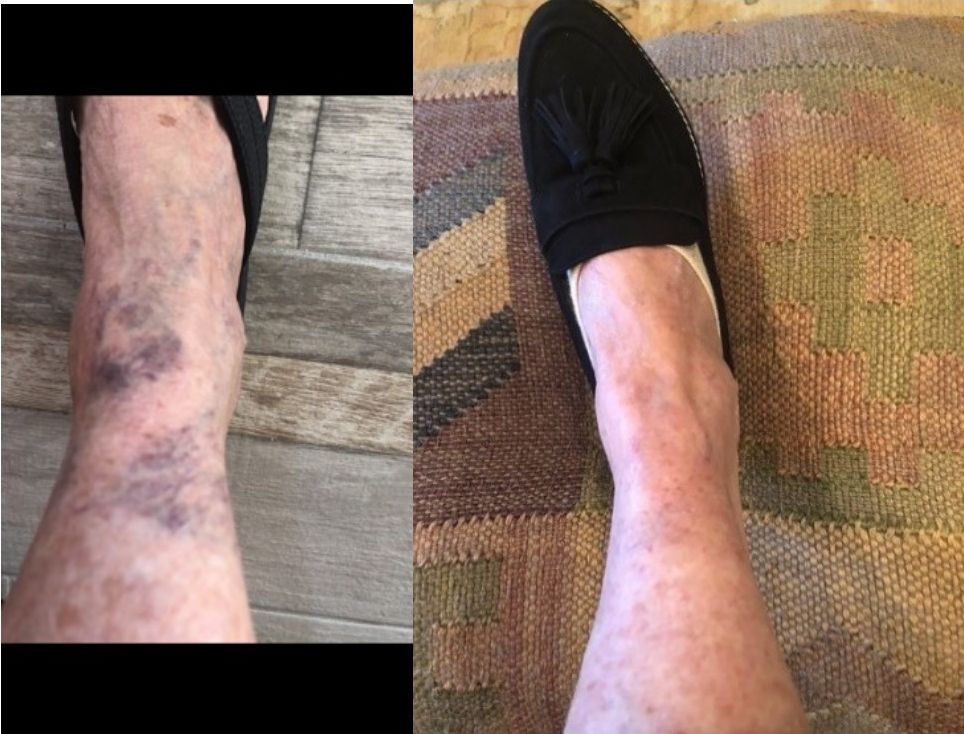 Before and after leg vein treatment