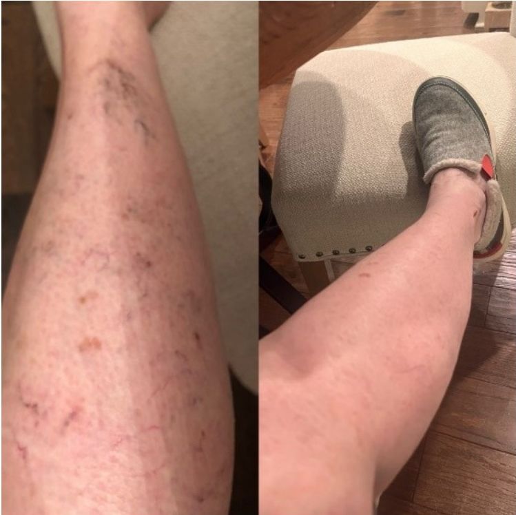 Before and after leg vein treatment results